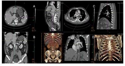 Case report: Anesthetic management for removal of tumor thrombus in the inferior vena cava and pulmonary artery in renal cell carcinoma